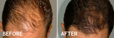 Before hair transplant surgery and after hair transplant surgery photos show the dramatic difference that Ava Hair Restoration clients can expect. Are you a man with male pattern baldness? Do you have hair loss or do you fear you're going bald? Ava Hair Restoration offers hair loss solutions for men's hair restoration, hair replacement, surgical and non-surgical hair restoration solutions. Ava Hair Restoration is a southern California hair restoration company, located in San Diego, California, in the pristine coastal community of Carlsbad, California. Local residents receive: Carlsbad hair restoration solutions, Encinitas hair restoration solutions, Oceanside hair restoration solutions, Del Mar hair restoration solutions, Rancho Santa Fe hair restoration solutions, La Jolla hair restoration solutions, and San Diego hair restoration solutions. At Ava Hair Restoration, you are always seen by a board certified, highly respected medical doctor and surgeon. Out of town patients bring their families and make a vacation out of their hair restoration, hair transplant procedure.